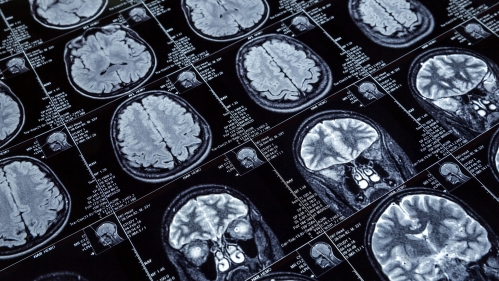 Brain mri