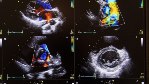 ultrasound of heart