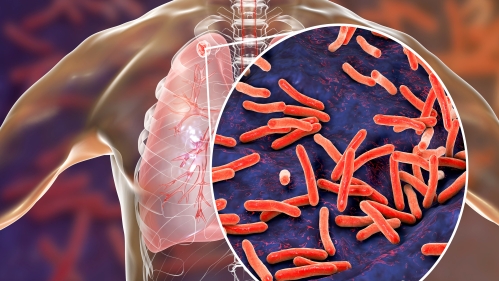 tuberculosis bacteria in illustrated lung