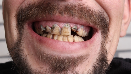 man with bad teeth