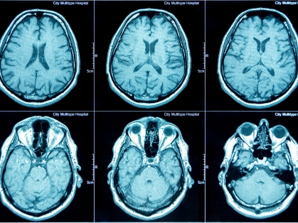 mri brain scan