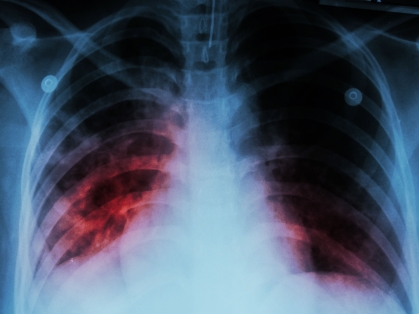 Tuberculosis